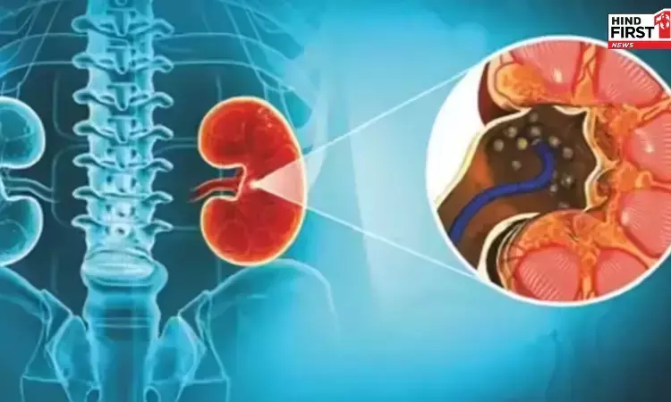 Summer Health Problem: गर्मियों में पथरी की समस्या बढ़ जाती है, जानिए कारण