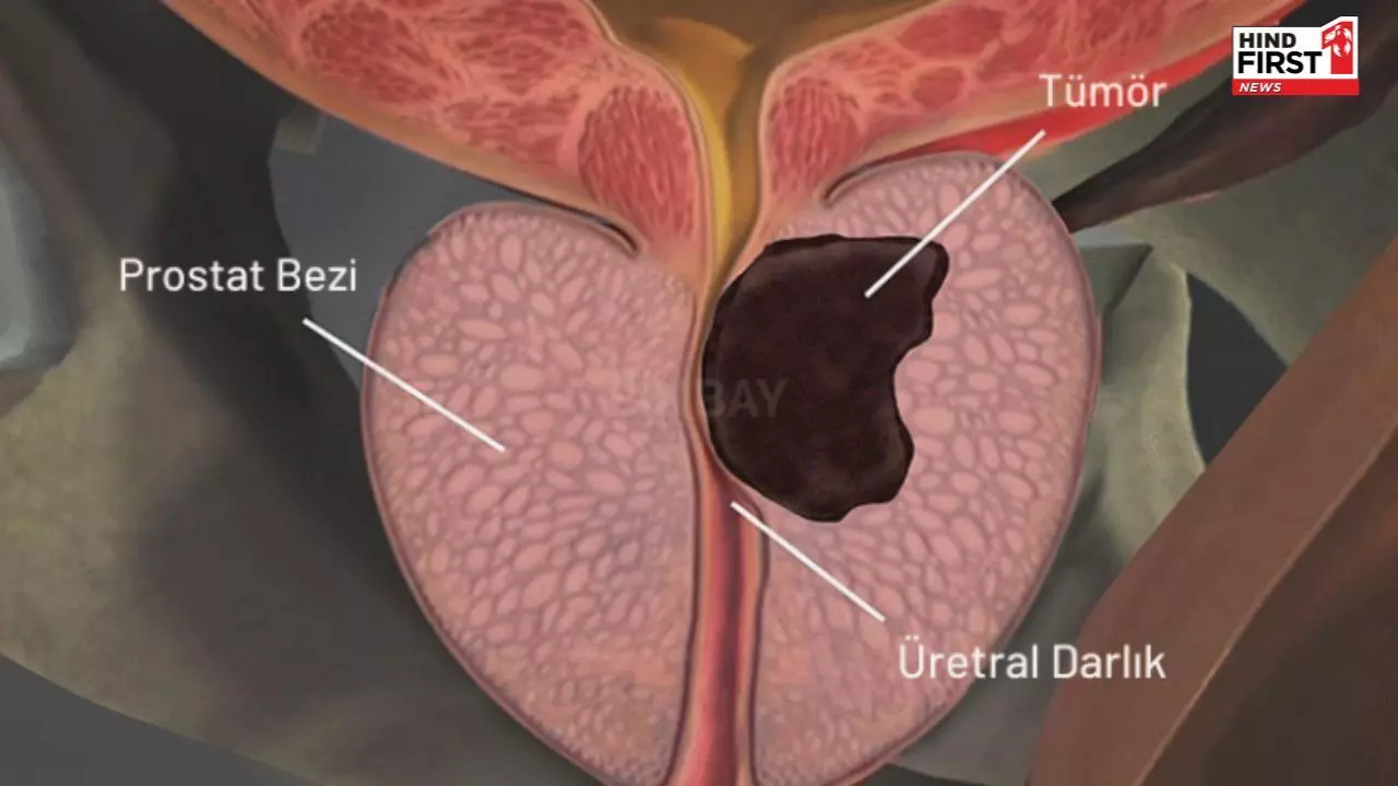 Prostate Cancer: प्रोस्टेट कैंसर के इन 5 लक्षणों को इग्नोर करने की ना करें गलती Prostate Cancer: प्रोस्टेट कैंसर के इन 5 लक्षणों को इग्नोर करने की ना करें गलती