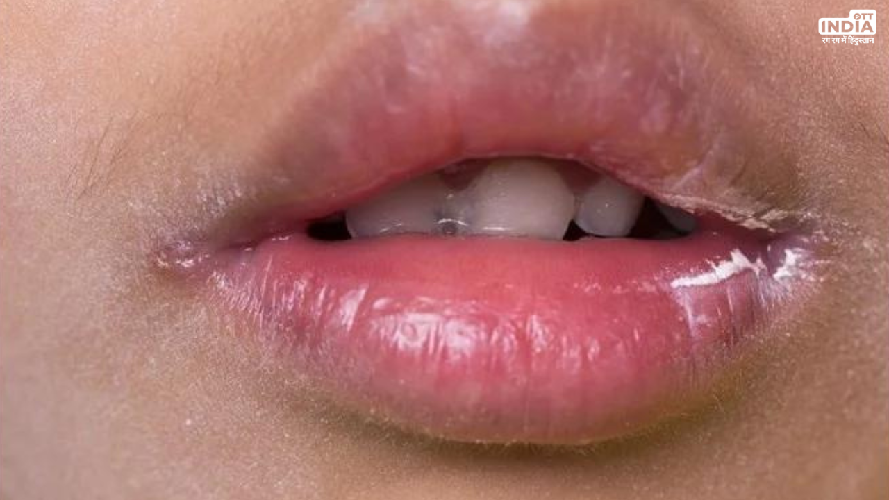 Angular Cheilitis Home Remedies: क्या आपके होठों के किनारों पर पड़ती हैं दरारें, जानें इसका घरेलु इलाज Angular Cheilitis Home Remedies: क्या आपके होठों के किनारों पर पड़ती हैं दरारें, जानें इसका घरेलु इलाज