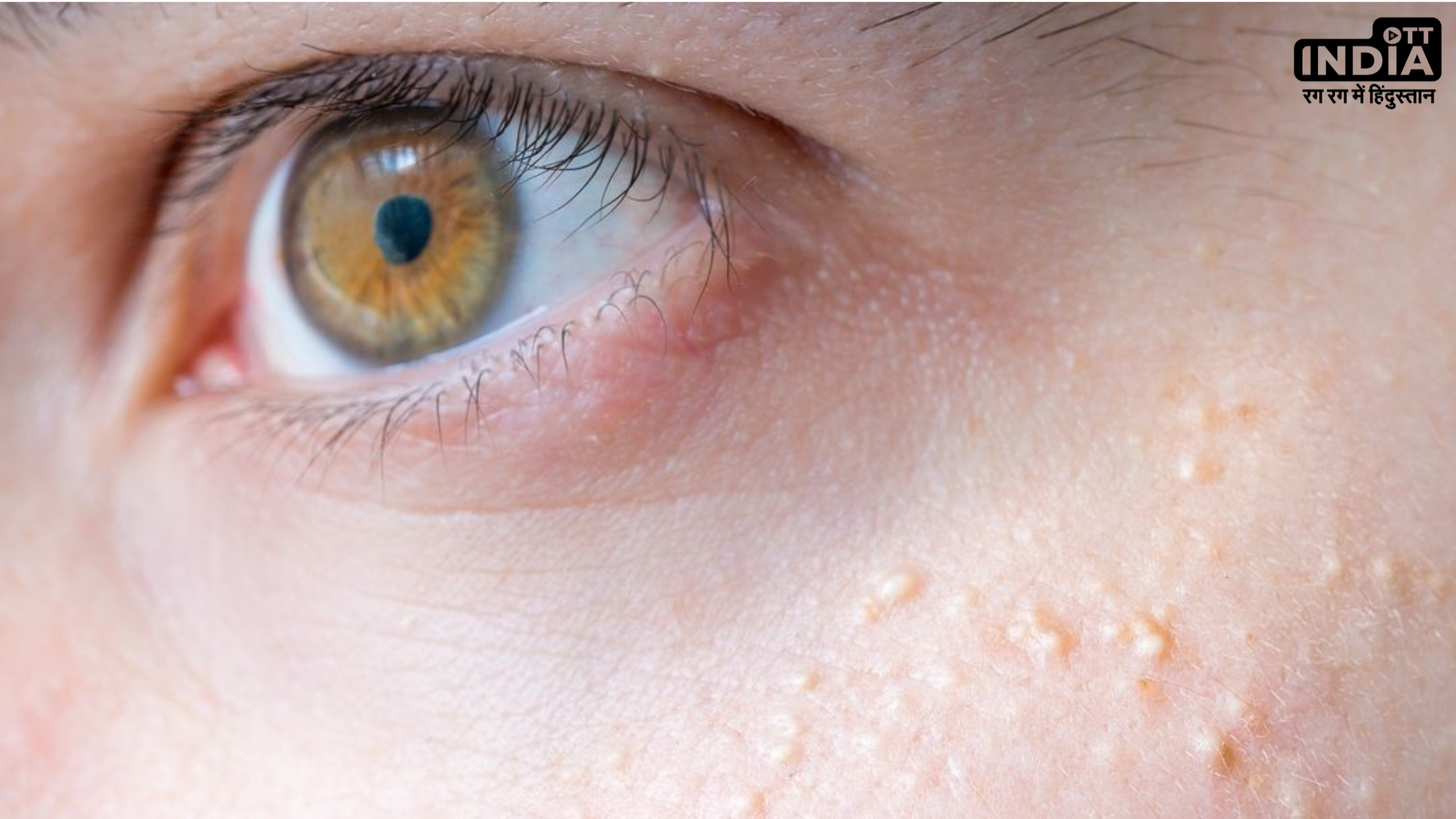 Whiteheads Home Remedies: व्हाइटहेड्स घटा देते हैं चेहरे की सुंदरता, जानें इसको दूर करने के घरेलू नुस्खे Whiteheads Home Remedies: व्हाइटहेड्स घटा देते हैं चेहरे की सुंदरता, जानें इसको दूर करने के घरेलू नुस्खे