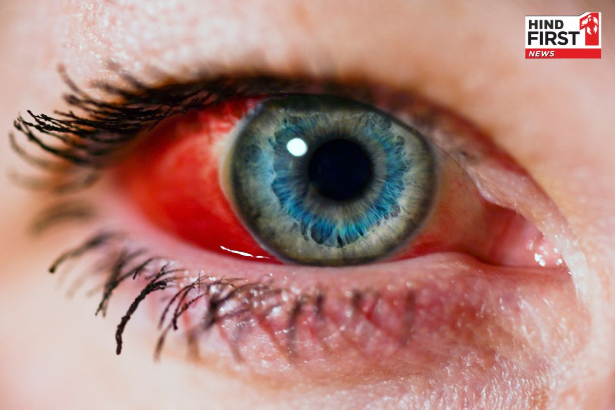 Bleeding Eye: आंखों से खून बहाने वाला खतरनाक वायरस फिर लौटा, जानें इस जानलेवा बीमारी के बारे में सब कुछ Bleeding Eye: आंखों से खून बहाने वाला खतरनाक वायरस फिर लौटा, जानें इस जानलेवा बीमारी के बारे में सब कुछ