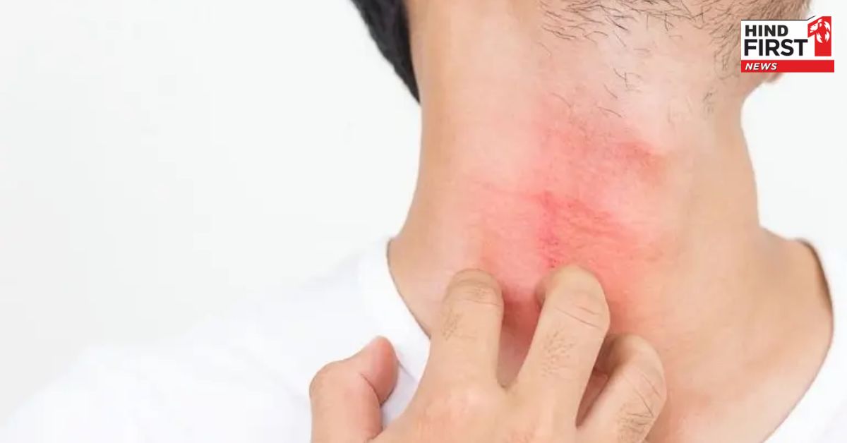 Home Remedies For Itching : खुजली से मुक्ति दिलाएंगे ये घरेलु उपाय, नहीं पड़ेगी डॉक्टर की जरुरत