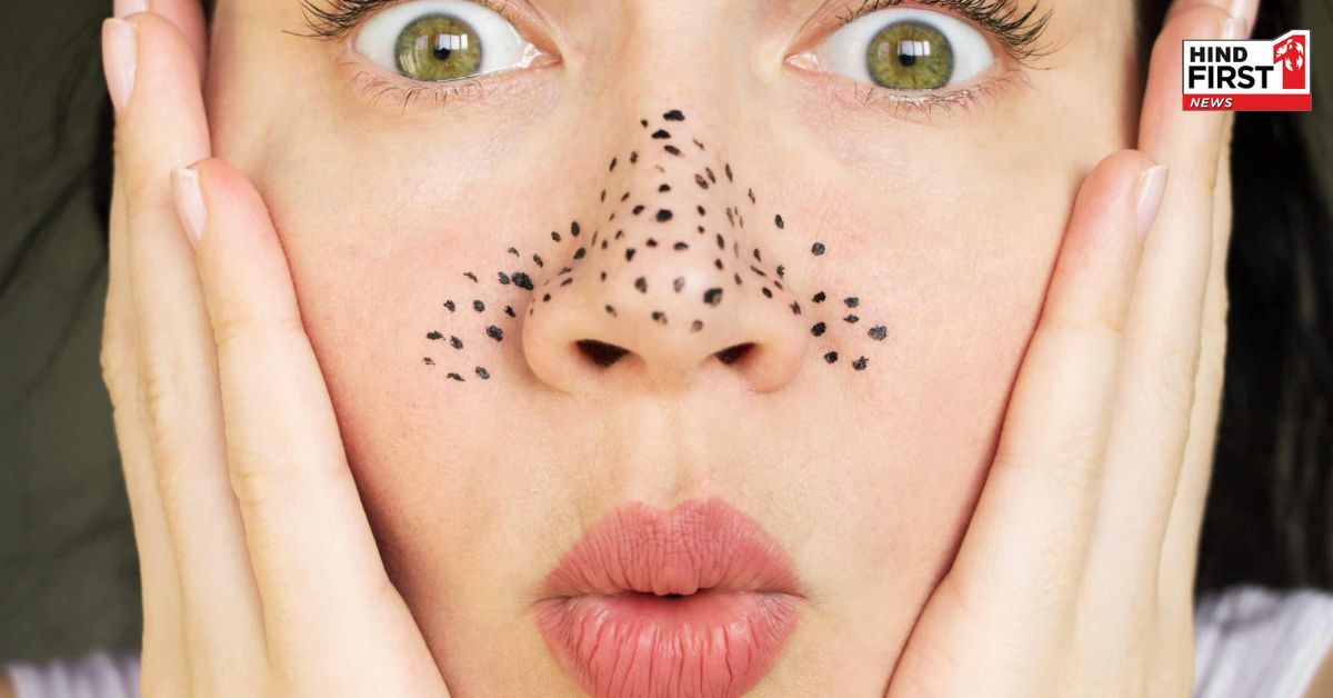 Blackheads Removal Tips: नाक के ब्लैकहेड्स और पिंपल से हैं परेशान ? ये एक नुस्खा दिलाएगा घर बैठे छुटकारा
