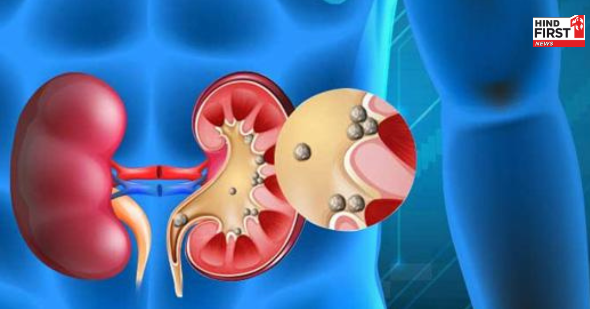 शरीर में क्यों बन जाती है पथरी? जानें इसके कारण और बचाव के तरीके