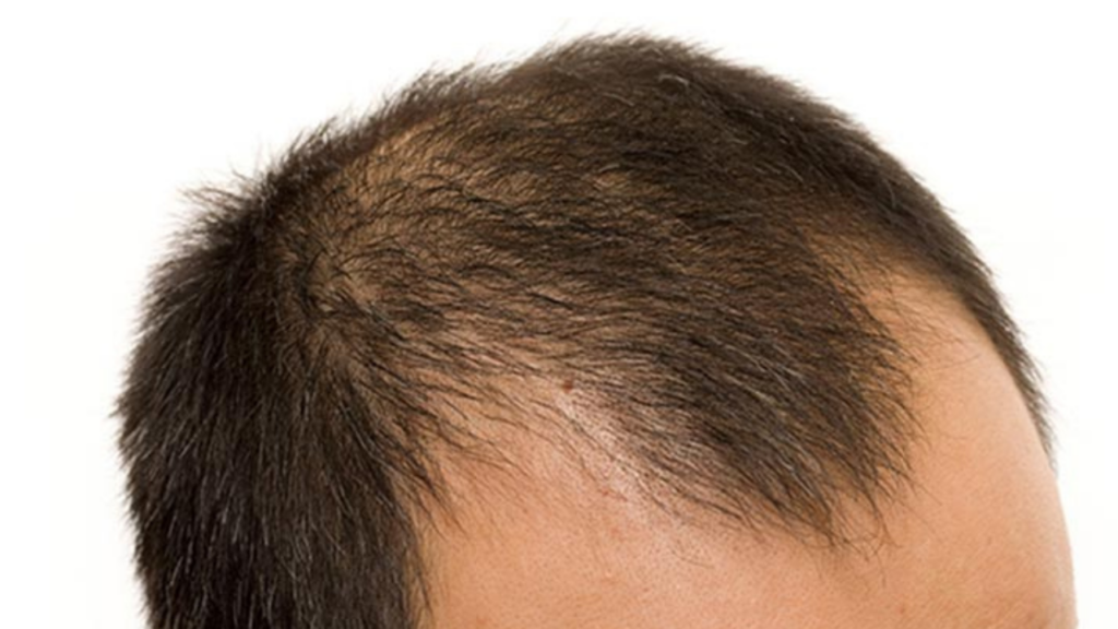 Hair Fall in Men: पुरुषों के बाल झड़ने के ये हैं पांच प्रमुख कारण, जानिए इसका इलाज 