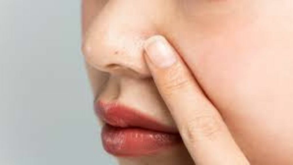 Blackheads Remedies: गर्मी में ब्लैकहेड्स से हैं परेशान तो अपनाएं ये घरेलू उपाय, मिलेगा आराम   