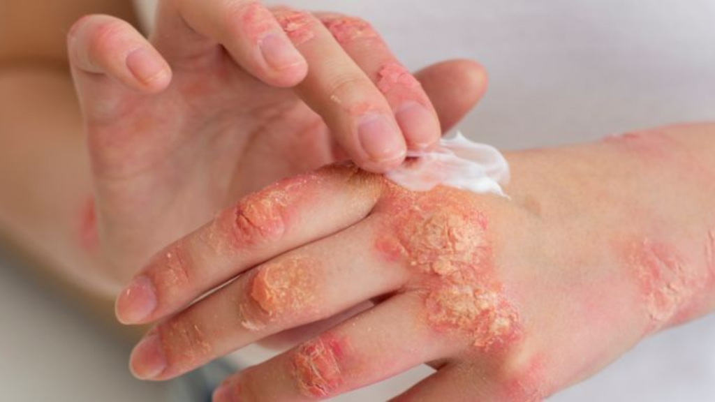 Skin Problems in Summer: पांच स्किन प्रॉब्लम जो गर्मियों में है आम बात, इन घरेलु उपायों से करें ठीक   