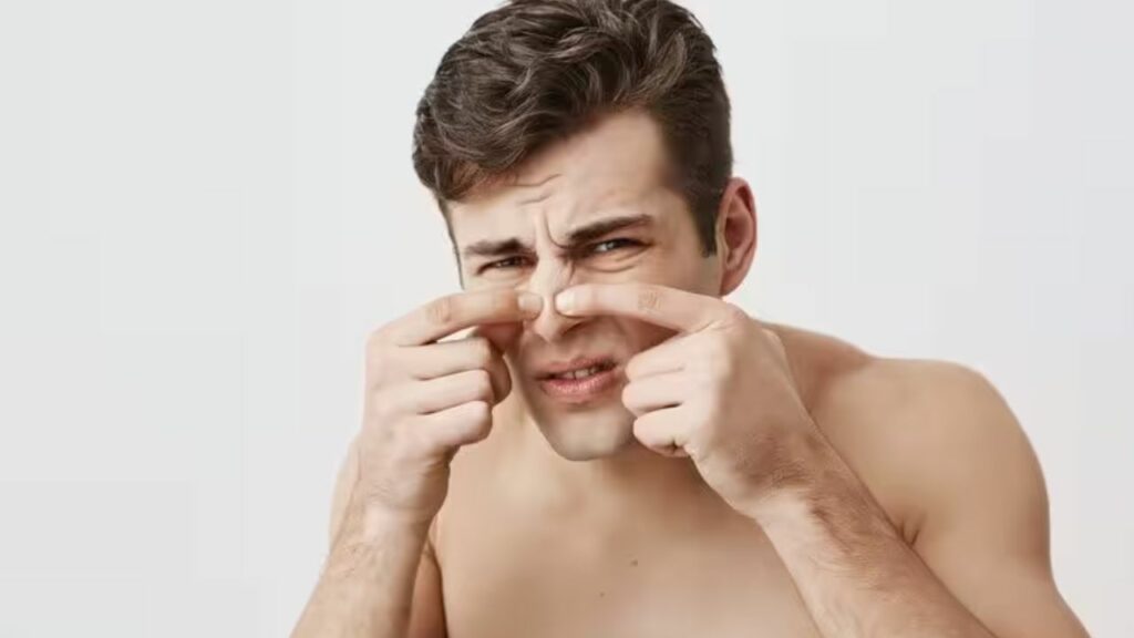 Blackheads Remedies: गर्मी में ब्लैकहेड्स से हैं परेशान तो अपनाएं ये घरेलू उपाय, मिलेगा आराम   