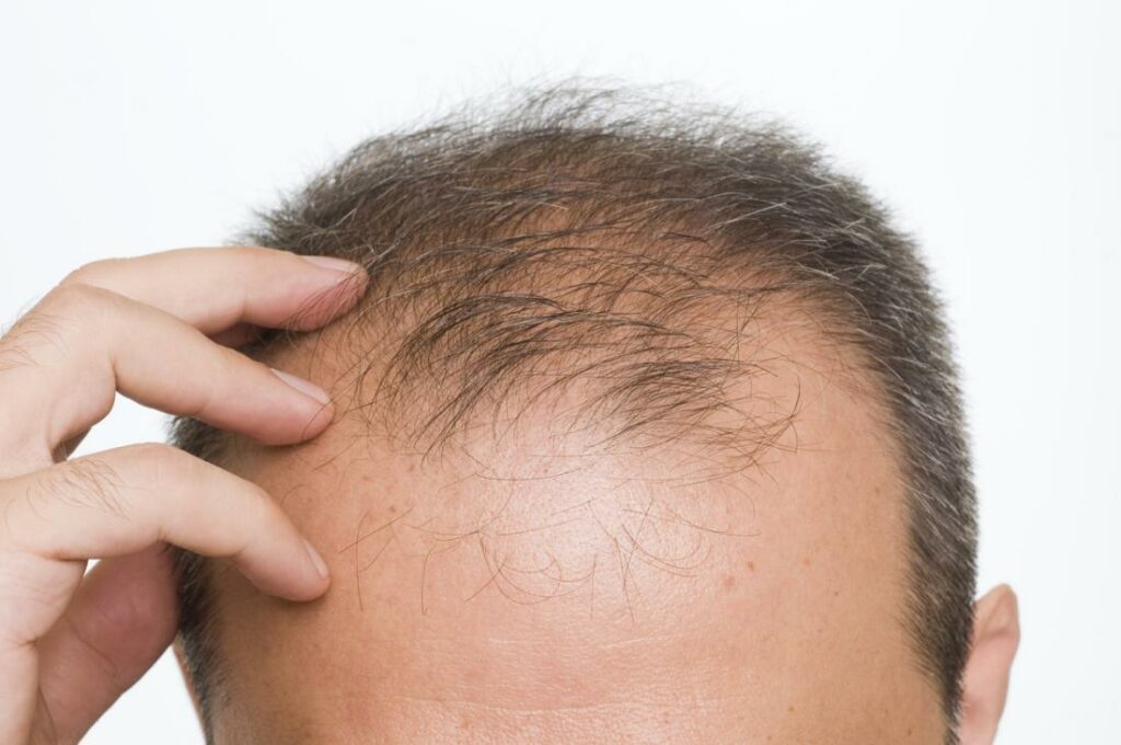 Hair Fall in Men: पुरुषों के बाल झड़ने के ये हैं पांच प्रमुख कारण, जानिए इसका इलाज 