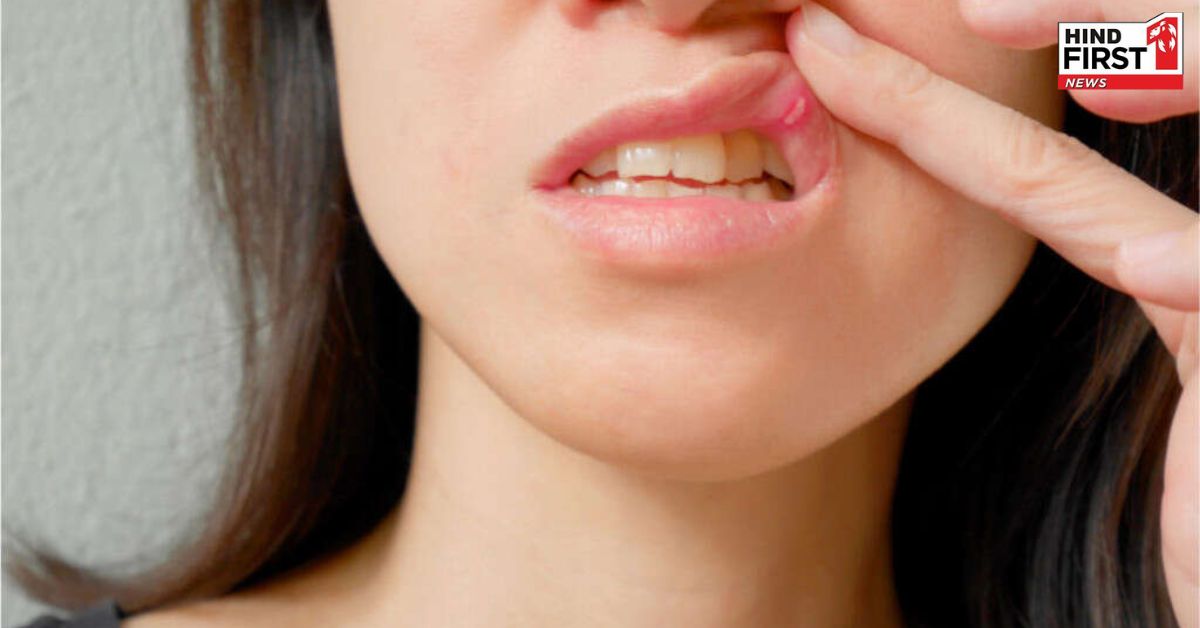 क्या आपको पता है बार-बार क्यों होते हैं मुंह के छालें, जाने इसके मुख्य कारण क्या आपको पता है बार-बार क्यों होते हैं मुंह के छालें, जाने इसके मुख्य कारण
