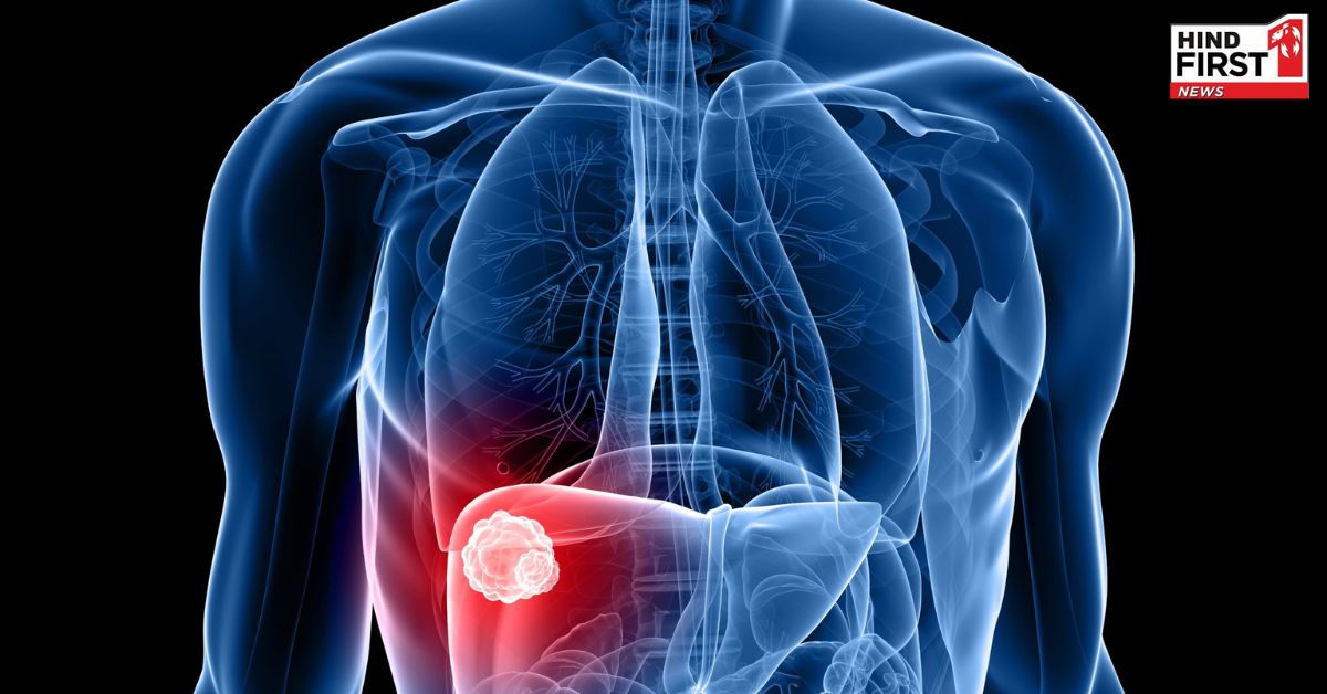 दीपिका कक्कड़ को हुआ स्टेज 2 लिवर कैंसर आप भी जानें इसके कारण, शुरुआती लक्षण और इलाज के बारे में