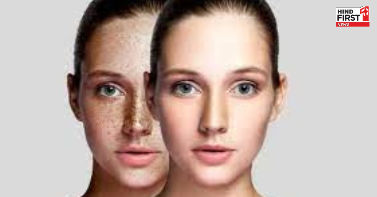 पिगमेंटेशन या काले धब्बों ने खूबसूरती पर लगा दिया है ग्रहण, तो इन उपायों से पाएं निजात पिगमेंटेशन या काले धब्बों ने खूबसूरती पर लगा दिया है ग्रहण, तो इन उपायों से पाएं निजात