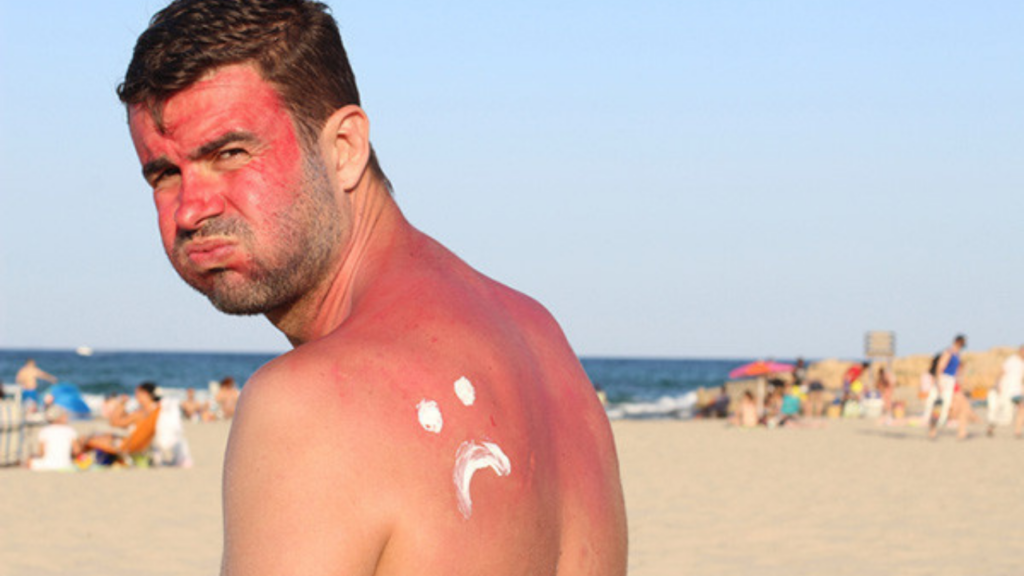 Sun Poisoning vs Sunburn: सन पॉइजनिंग और सनबर्न में होता है अंतर, जानें लक्षण और इलाज   