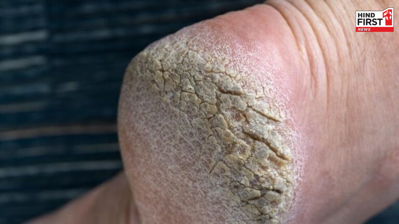 Cracked Heels Remedies: फटी एड़ियों से हैं परेशान, ये पांच घरेलु इलाज दिलाएंगे आराम Cracked Heels Remedies: फटी एड़ियों से हैं परेशान, ये पांच घरेलु इलाज दिलाएंगे आराम