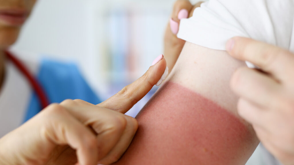 Sun Poisoning vs Sunburn: सन पॉइजनिंग और सनबर्न में होता है अंतर, जानें लक्षण और इलाज   