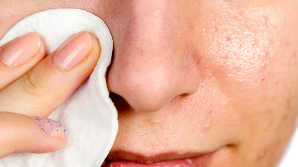 Blackheads Remedies: इन पांच घरेलु उपयों से ब्लैकहेड्स करें दूर, बढ़ जाएगी सुंदरता    