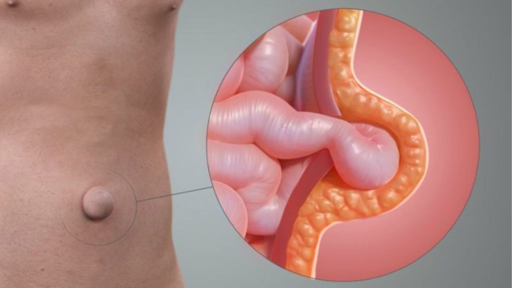 Health Is Wealth: इन कुछ गलतियों के कारण हर्निया होने का बढ़ जाता है खतरा, ऐसे बरतें सावधानी