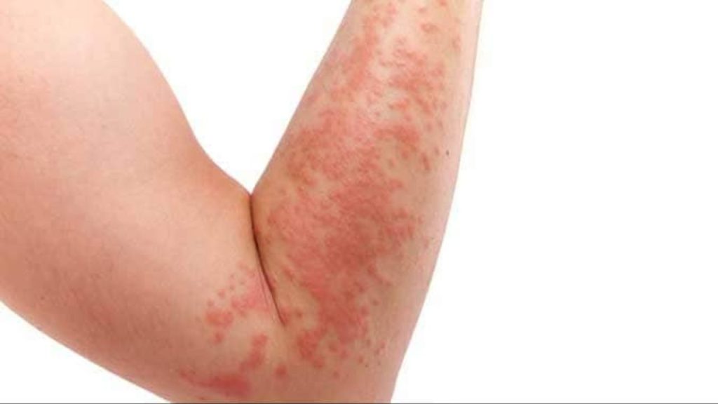 Kidney Disease: चेहरे और गर्दन पर नजर आते हैं किडनी रोग के लक्षण, आप भी जानें  