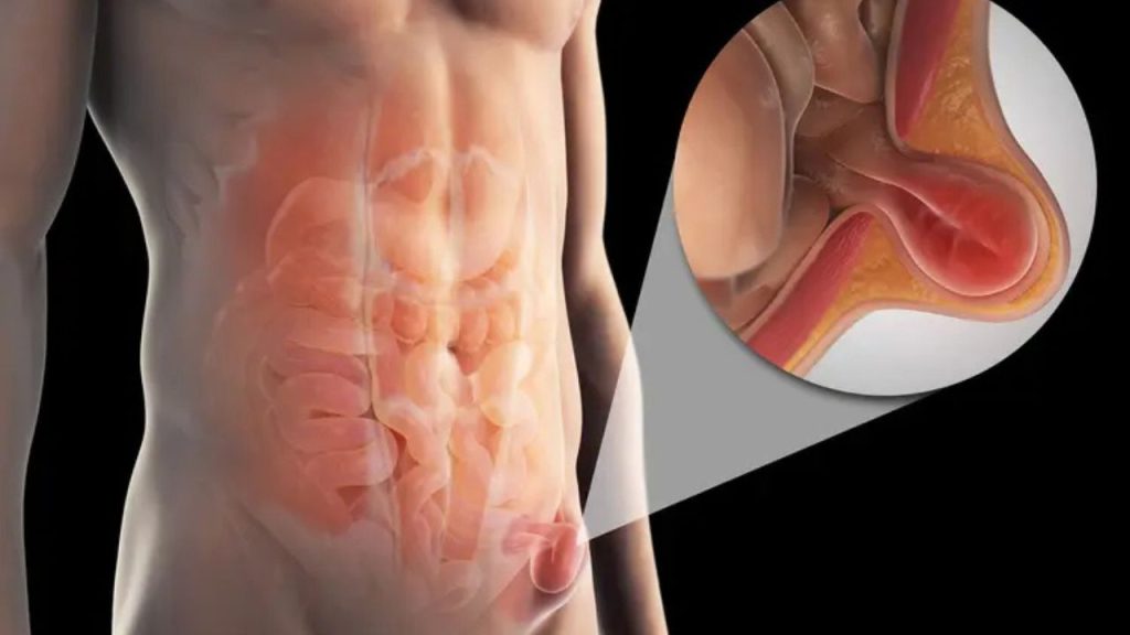 Health Is Wealth: इन कुछ गलतियों के कारण हर्निया होने का बढ़ जाता है खतरा, ऐसे बरतें सावधानी 