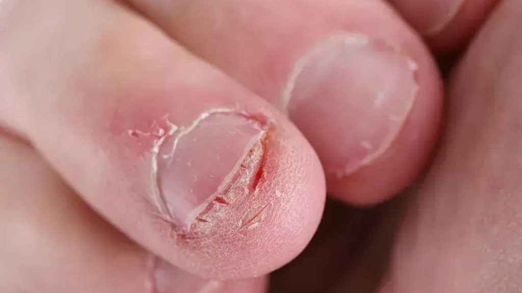   Nail Biting Habit : दांतों से नाखून कुतरने की आदत कई बिमारियों की है जड़ , आज ही छोड़ दें   