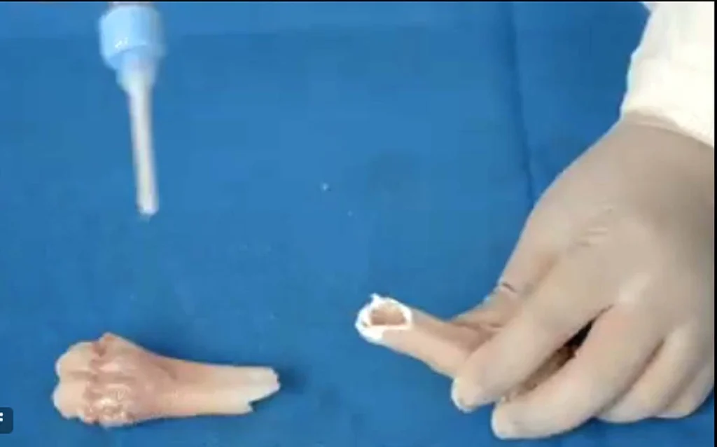 Bone Glue: चीनी वैज्ञानिकों ने बनाया 'बोन ग्लू', केवल 3 मिनट में जोड़ेगा फ्रैक्चर!  