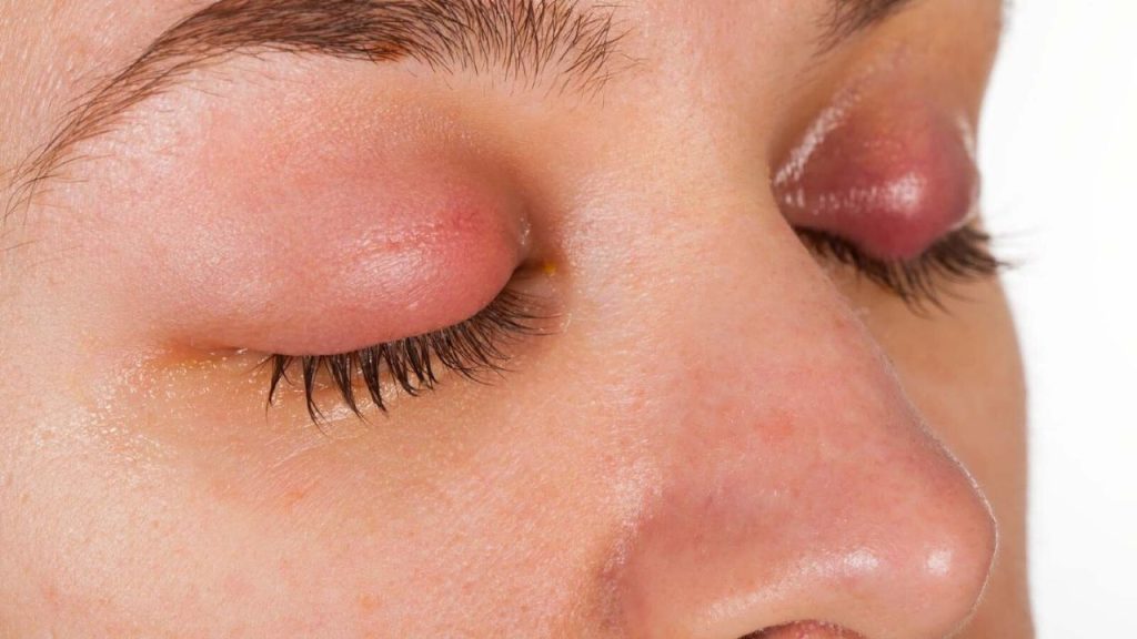 Conjunctivitis: कंजक्टिवाइटिस के इन शुरूआती लक्षणों को ना करें इग्नोर, वरना हो सकती है बड़ी परेशानी