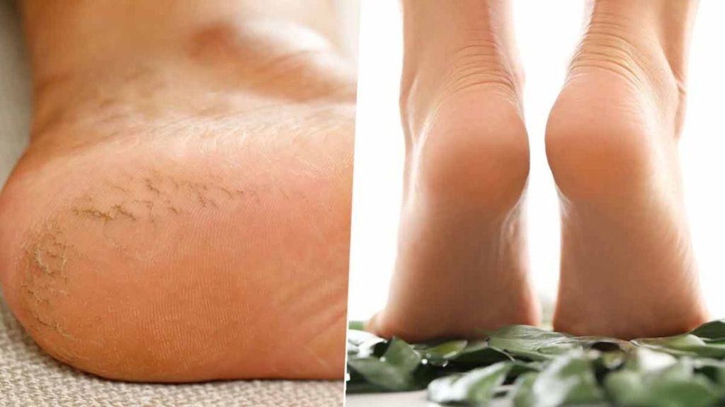Winter Care Tips: सर्दियों में फटी एड़ियों से ना हो शर्मिंदा, इन घरेलू तरीकों से करें ठीक