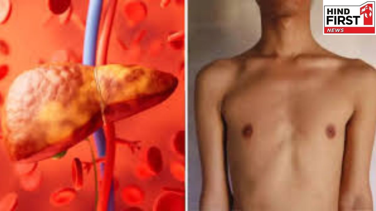 Fatty Lever  Symptoms: लक्षणों को मामूली समझने की ना करें भूल हो सकते हैं फैटी लिवर के संकेत